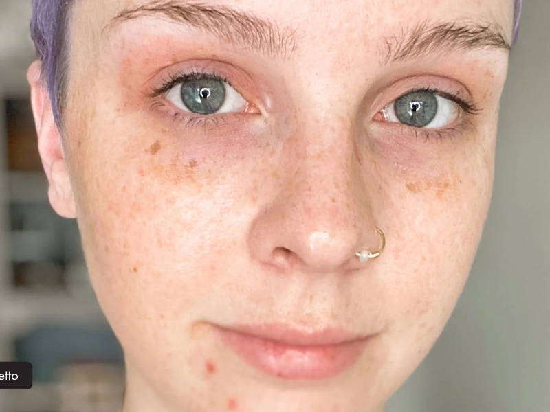 Essayez ces conseils, qui pourraient aider à améliorer l’apparence des taches de vieillesse.